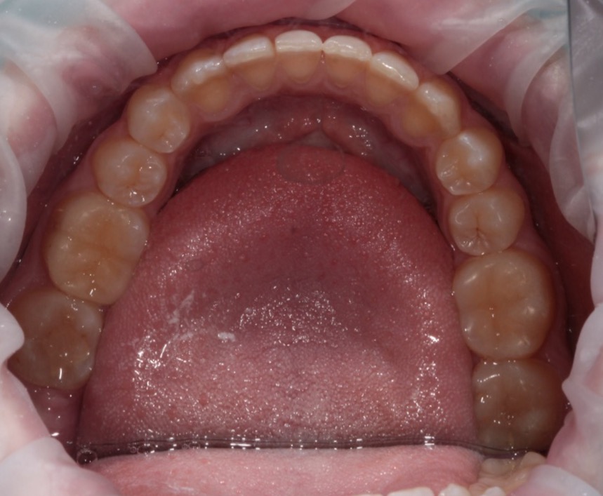 После лечения 